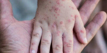 No concern yet monkeypox will cause pandemic: WHO